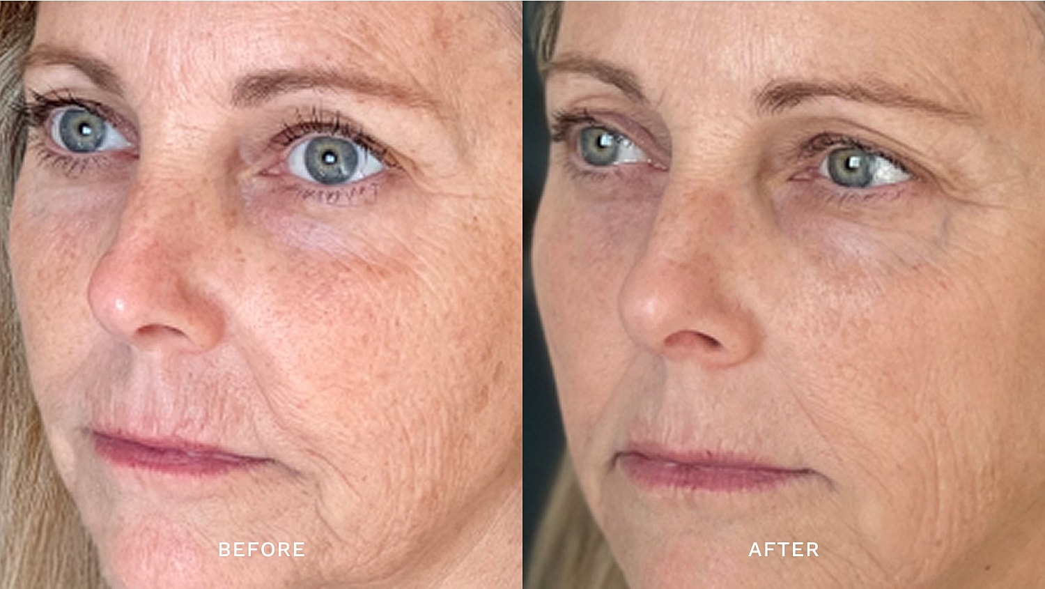 Before and after skin rejuvenation treatment comparison.