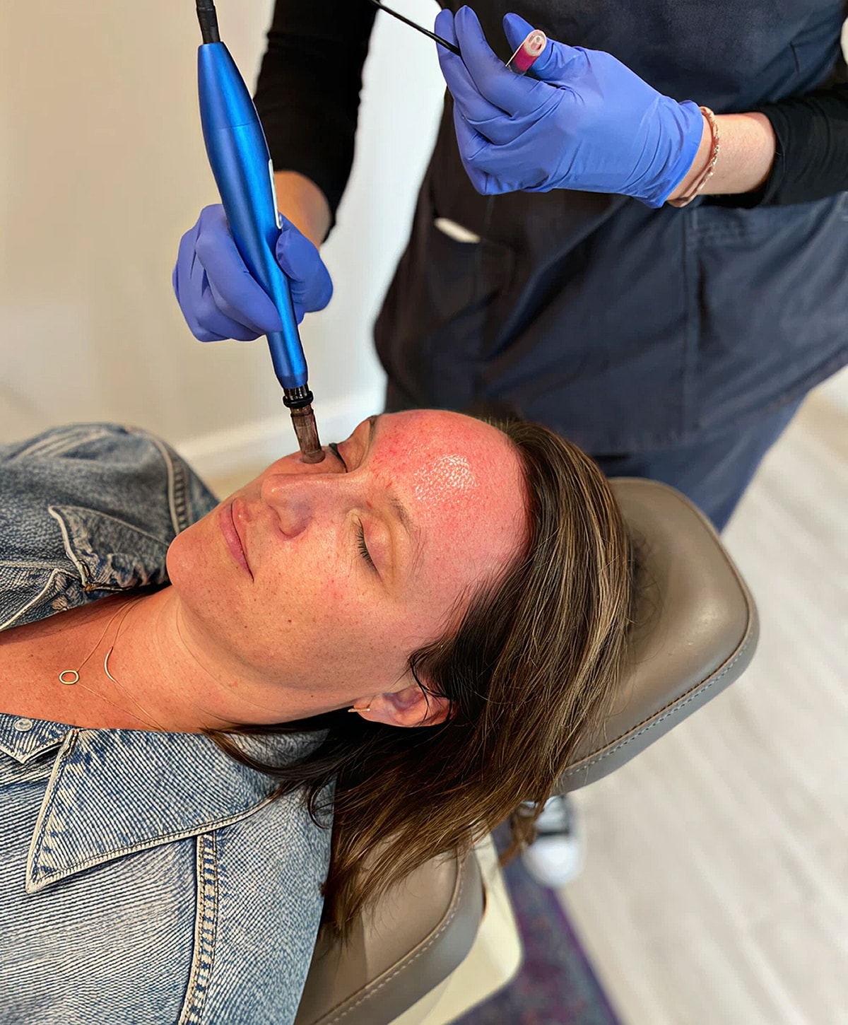 Facial treatment using a microblading device.