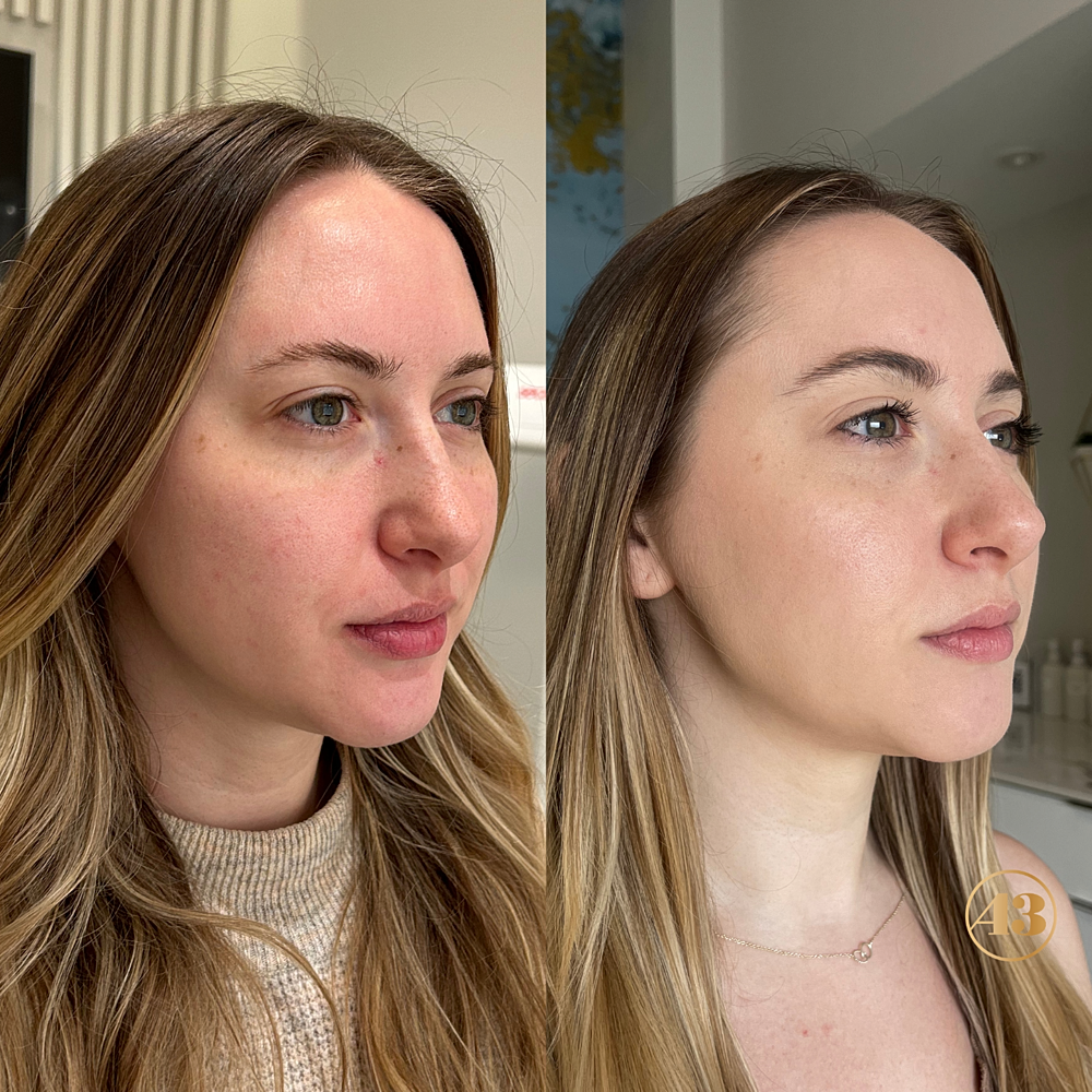 Wedding Skin Prep Before & After