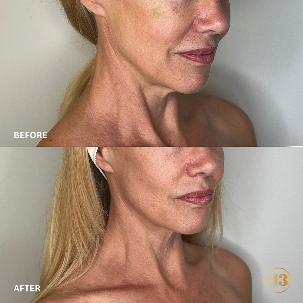 Morpheus8 Before & After