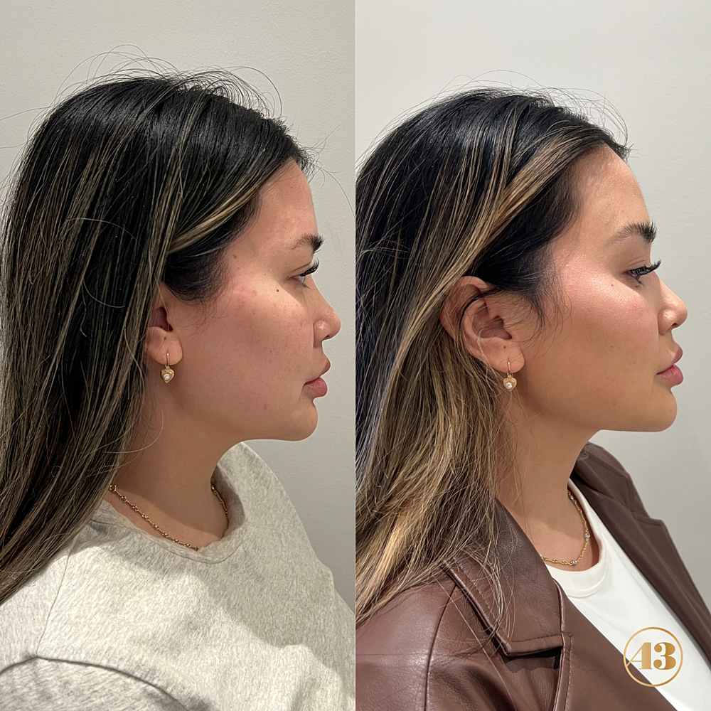 Morpheus8 Before & After