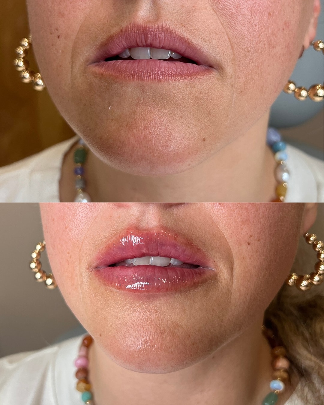 Lip Filler Before & After