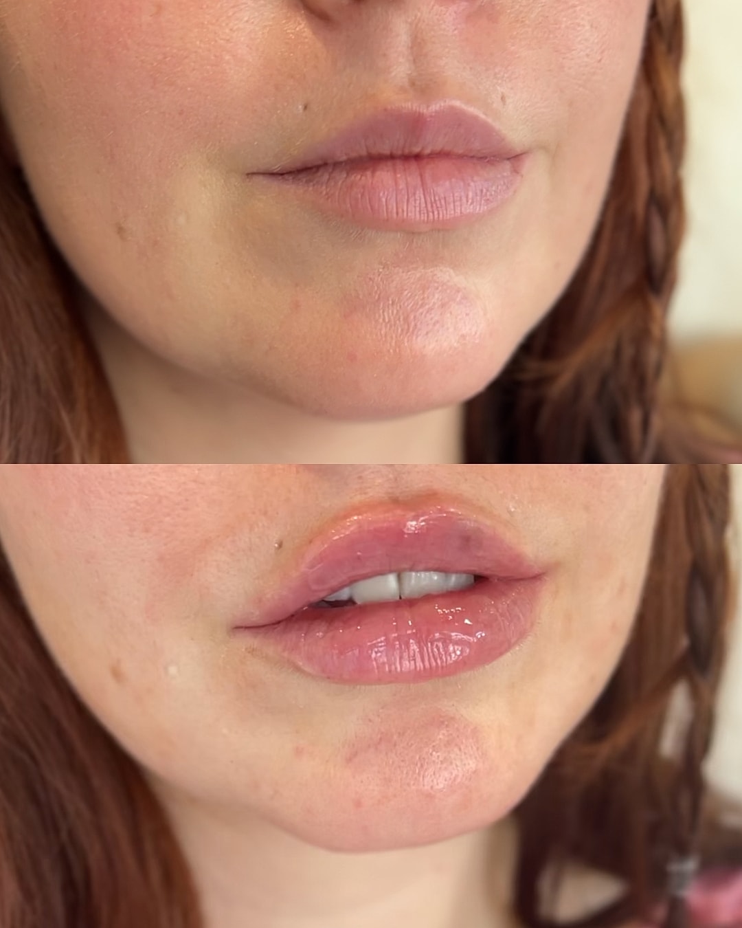 Lip Filler Before & After