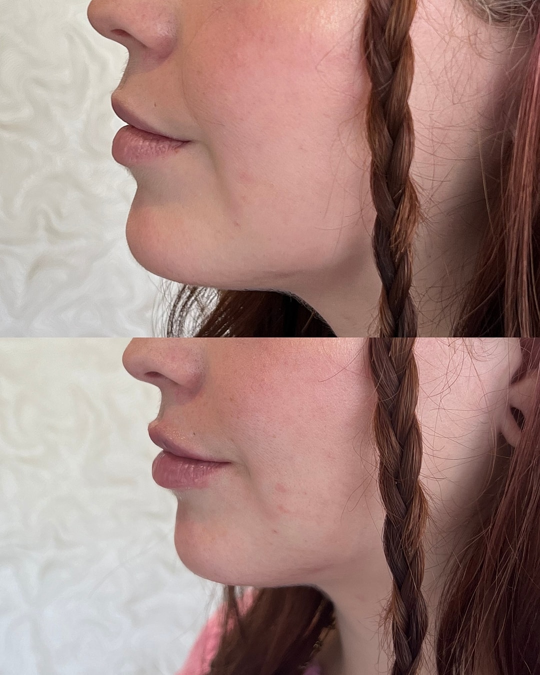 Lip Filler Before & After