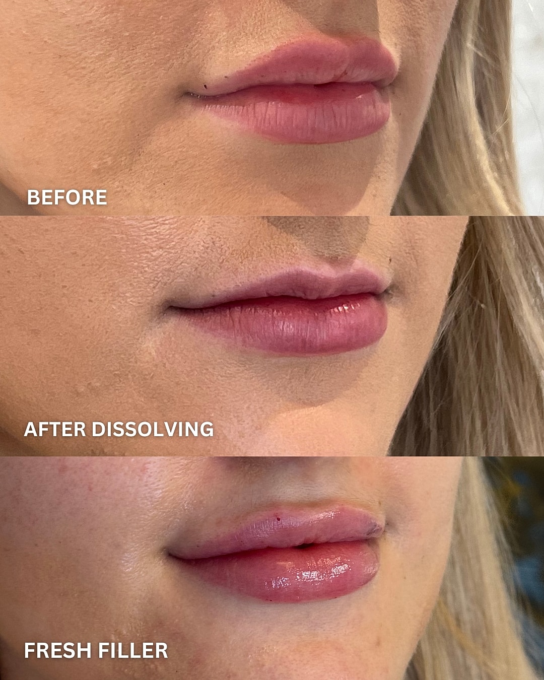 Lip Filler Before & After