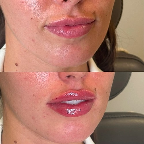 Lip Filler Before & After