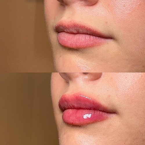 Lip Filler Before & After