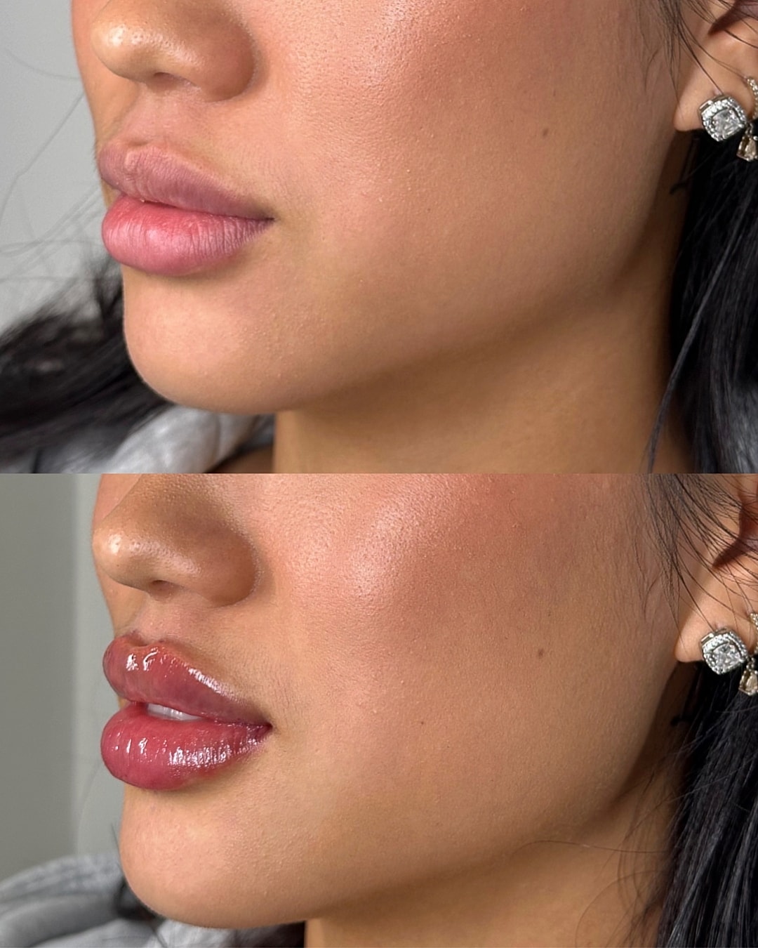 Lip Filler Before & After