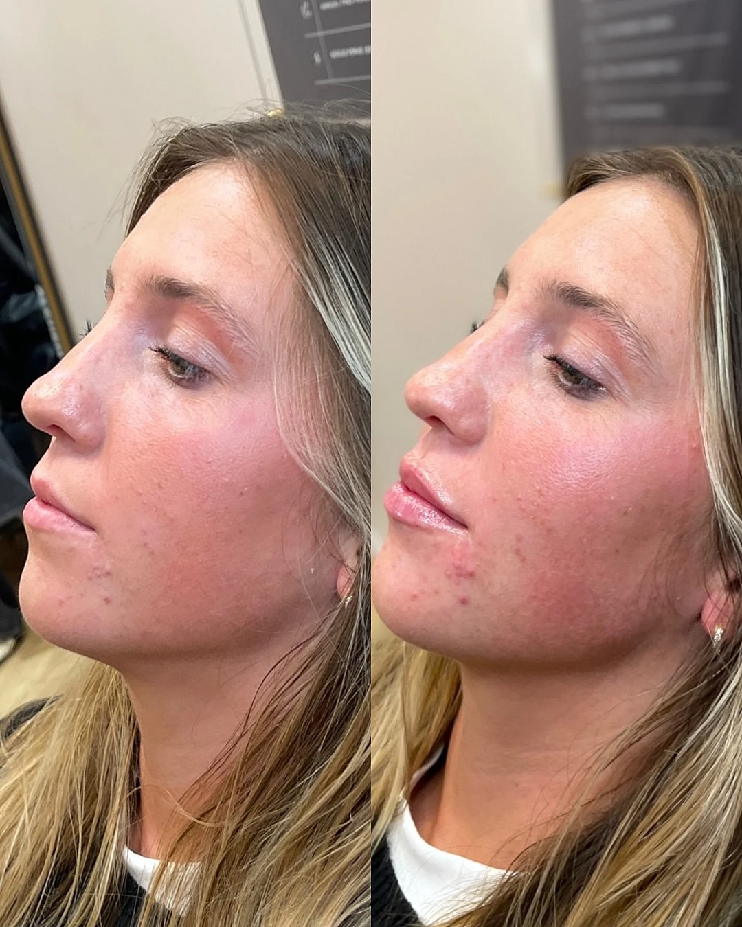 Lip Filler Before & After