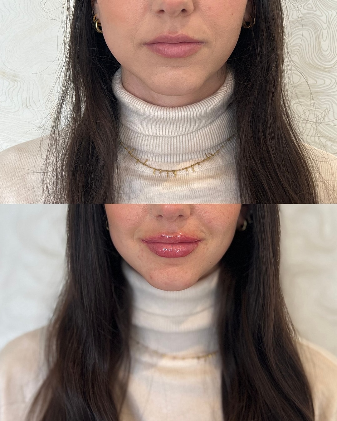 Lip Filler Before & After