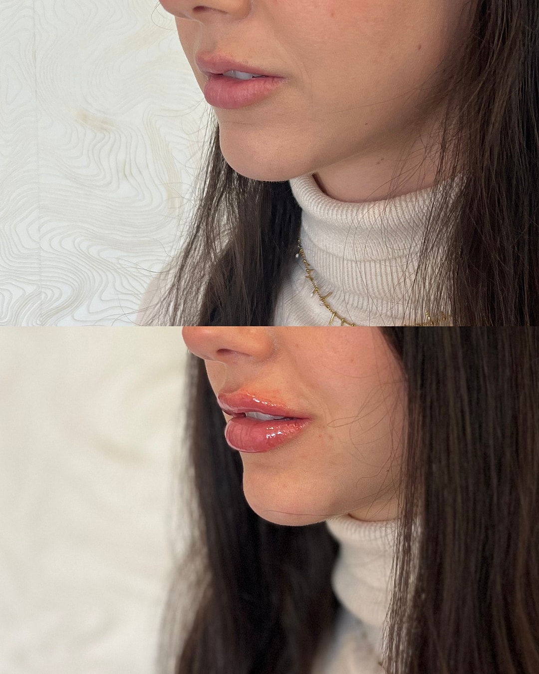 Lip Filler Before & After