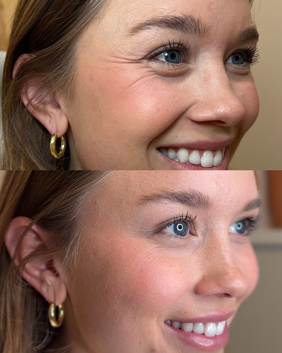 Botox Before & After