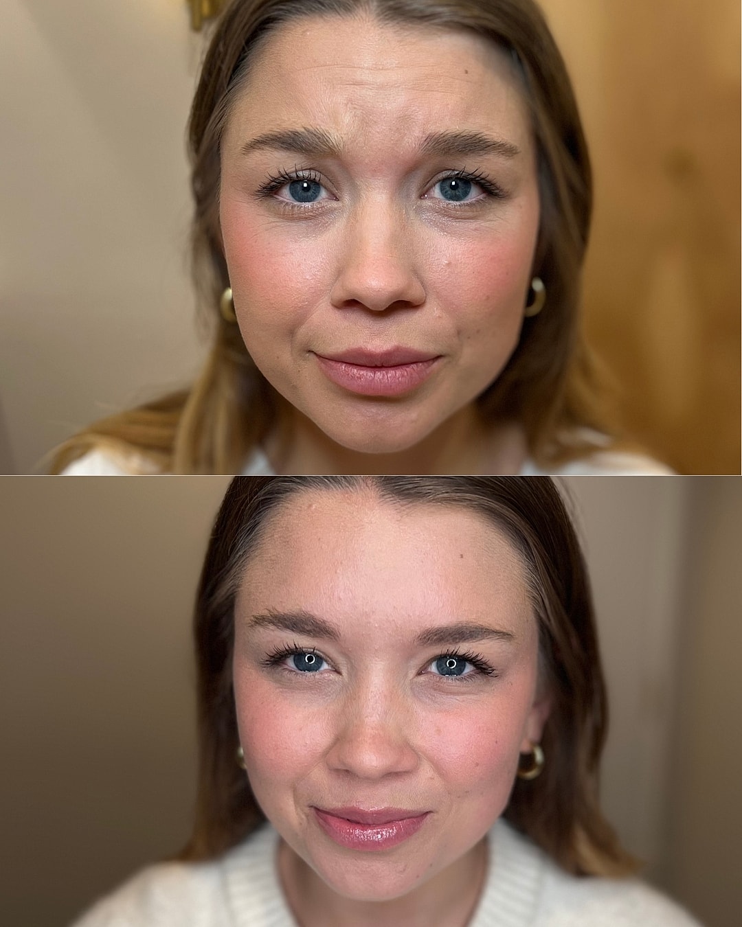 Botox Before & After