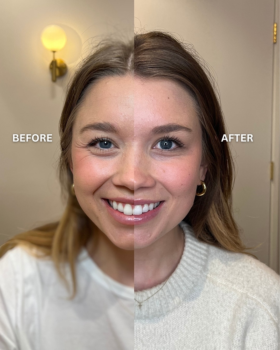 Botox Before & After