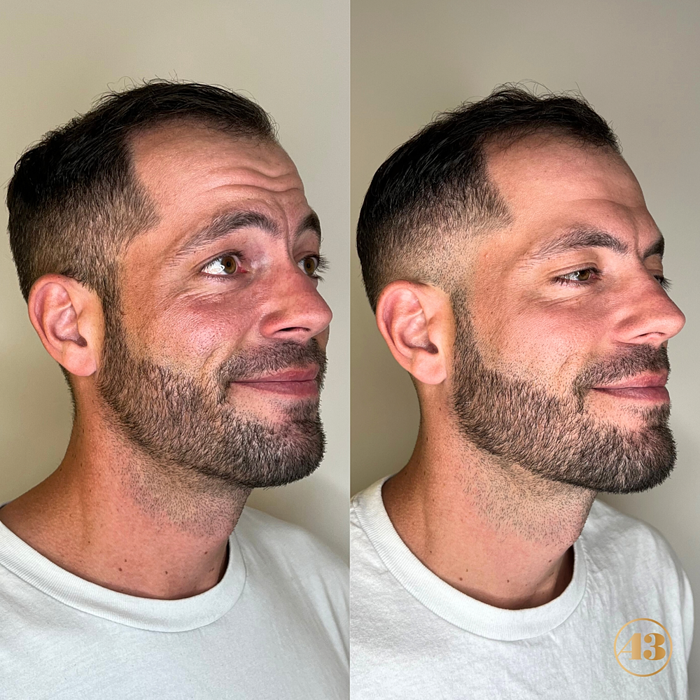 Botox Before & After