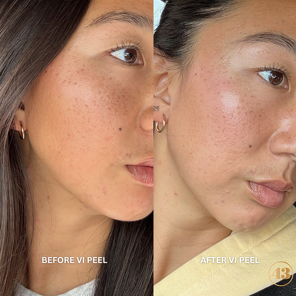 Vi Peel Before & After