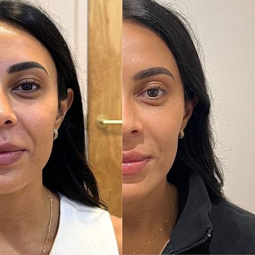Masseter Botox Before & After