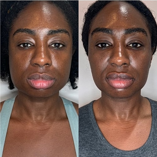 Masseter Botox Before & After
