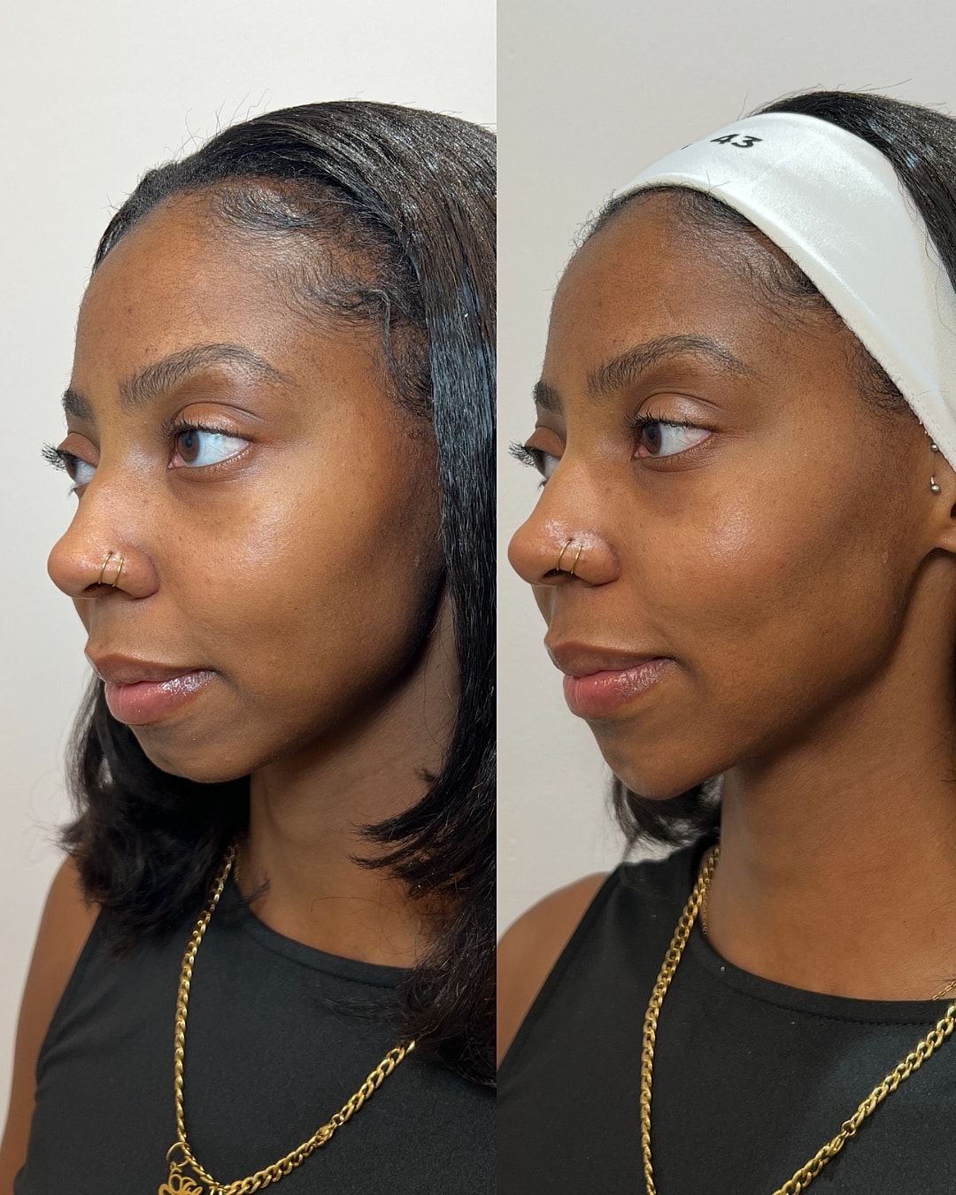 Dermal Fillers Before & After