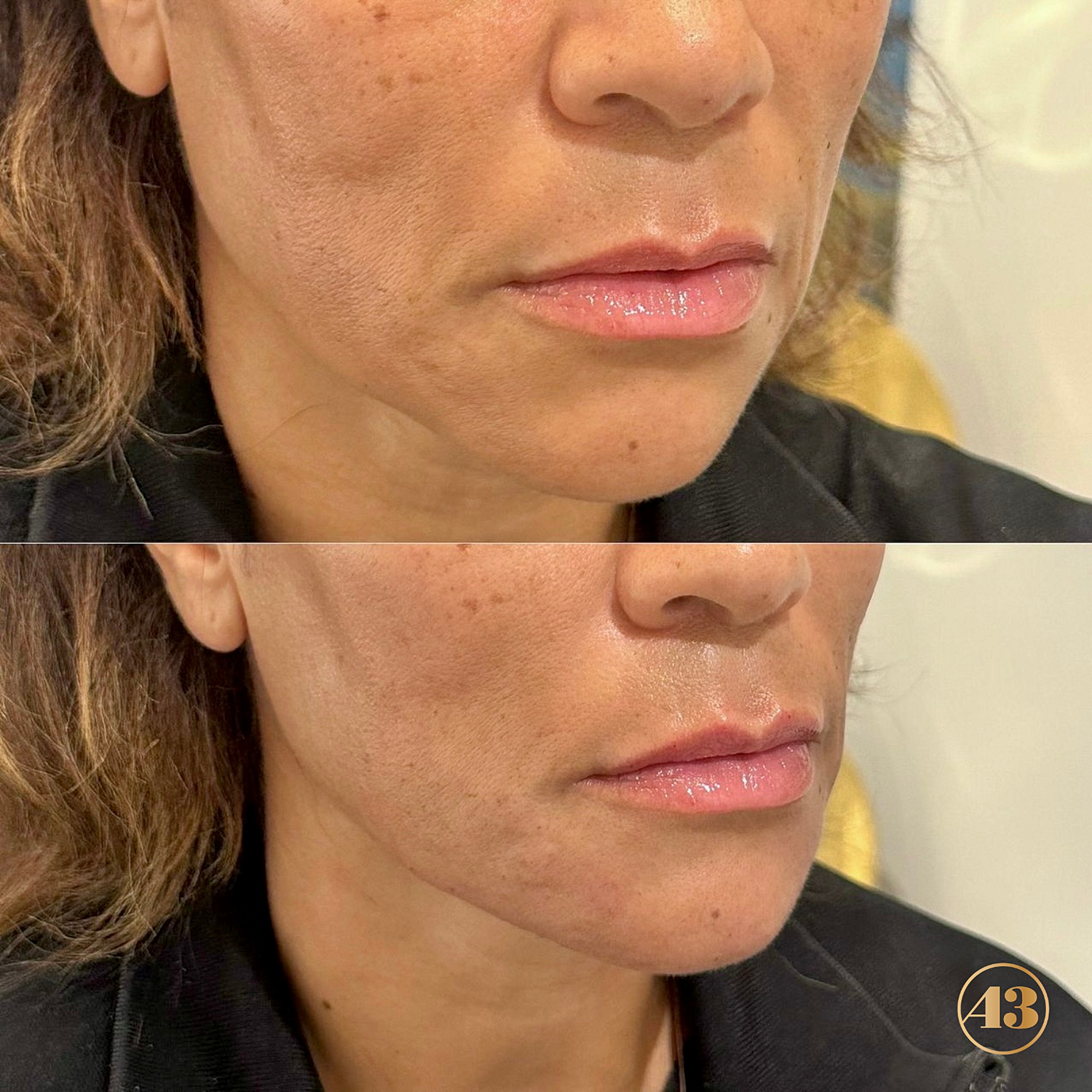 Dermal Fillers Before & After